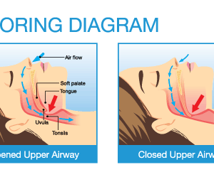 Snoring & Sleep Apnea – Eastern Virginia Ear, Nose & Throat Specialists