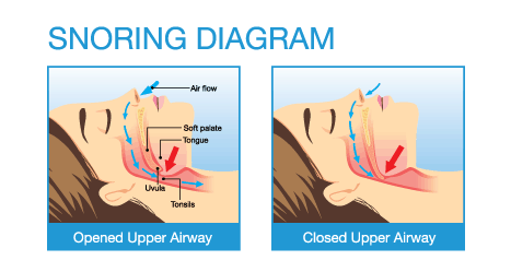 Anatomy Of Woman While Normal Sleeping And Have Snoring