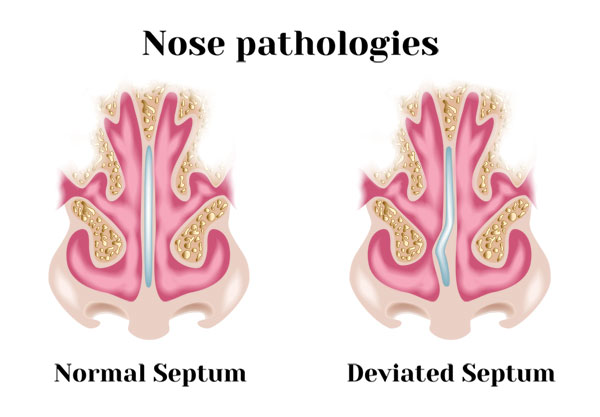 Deviated Septum