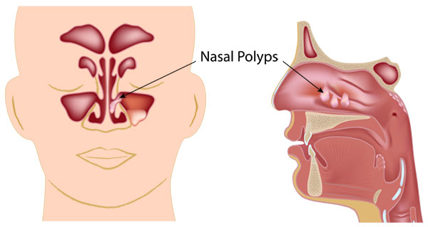 Nasal Polyps