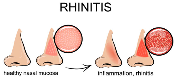 Rhinitis